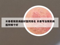 长春看银屑病最好医院排名 长春专治银屑病医院哪个好