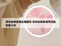 郑州治银屑病正规医院 郑州治银屑病专科医院哪个好