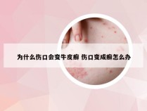 为什么伤口会变牛皮癣 伤口变成癣怎么办