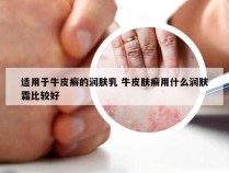 适用于牛皮癣的润肤乳 牛皮肤癣用什么润肤霜比较好