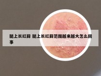 腿上长红藓 腿上长红藓范围越来越大怎么回事
