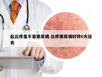 起丘疹是不是银屑病 丘疹银屑病好转6大征兆