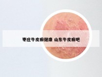 枣庄牛皮癣健康 山东牛皮癣吧