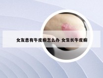 女友患有牛皮癣怎么办 女生长牛皮癣