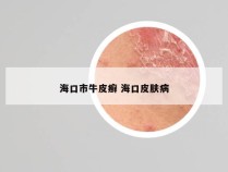 海口市牛皮癣 海口皮肤病