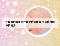 牛皮癣的毒素吃什么中药能排毒 牛皮癣内服中药秘方