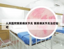 人民医院银屑病关节炎 银屑病关节炎治愈贴吧