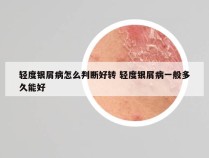轻度银屑病怎么判断好转 轻度银屑病一般多久能好
