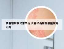 长春银屑病只来华山 长春华山银屑病医院好不好