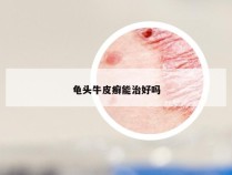龟头牛皮癣能治好吗