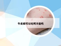 牛皮癣可以吃烤冷面吗