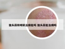 独头蒜和明矾冶癣能吗 独头蒜能治病吗