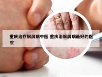 重庆治疗银屑病中医 重庆治银屑病最好的医院