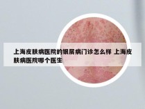 上海皮肤病医院的银屑病门诊怎么样 上海皮肤病医院哪个医生
