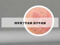 四岁得了牛皮癣 孩子牛皮癣