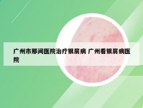 广州市那间医院治疗银屑病 广州看银屑病医院