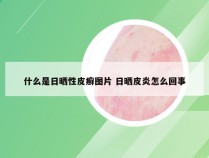 什么是日晒性皮癣图片 日晒皮炎怎么回事