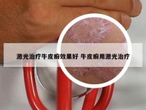 激光治疗牛皮癣效果好 牛皮癣用激光治疗