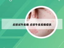 点状试牛皮癣 点状牛皮皮癣症状