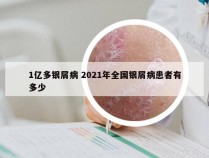1亿多银屑病 2021年全国银屑病患者有多少