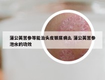 蒲公英苦参等能治头皮银屑病么 蒲公英苦参泡水的功效
