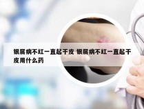 银屑病不红一直起干皮 银屑病不红一直起干皮用什么药