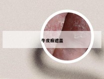 牛皮癣遮盖