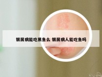 银屑病能吃黑鱼么 银屑病人能吃鱼吗
