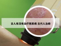 古人有没有治疗银屑病 古代人治癣