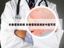 长春看银屑病 长春看银屑病老中医专家