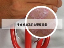 牛皮癣复发的主要原因是