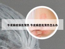 牛皮癣皮损出发热 牛皮癣患处发热怎么办