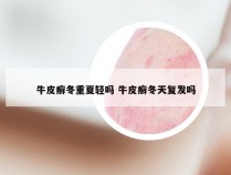 牛皮癣冬重夏轻吗 牛皮癣冬天复发吗