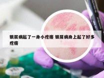 银屑病起了一身小疙瘩 银屑病身上起了好多疙瘩