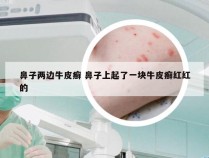 鼻子两边牛皮癣 鼻子上起了一块牛皮癣红红的
