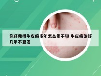 你好我得牛皮癣多年怎么能不犯 牛皮癣治好几年不复发