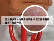 雷公藤多苷片治银屑病效果好 雷公藤多苷片治疗牛皮癣咋样