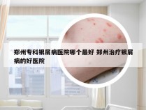 郑州专科银屑病医院哪个最好 郑州治疗银屑病的好医院