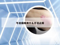 牛皮癣痒用什么方法止痒