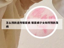 怎么预防遗传银屑病 银屑病子女如何预防发病