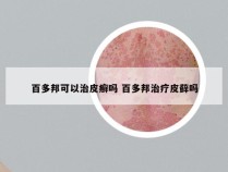 百多邦可以治皮癣吗 百多邦治疗皮藓吗
