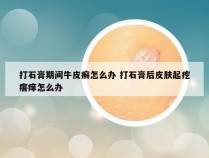 打石膏期间牛皮癣怎么办 打石膏后皮肤起疙瘩痒怎么办