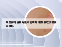 牛皮癣吃消银片能不能有用 银屑病吃消银片管用吗