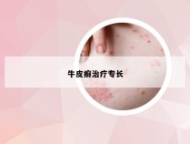 牛皮癣治疗专长