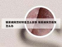 银屑病突然好转是怎么回事 银屑病突然爆发怎么办