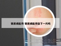 银屑病能传 银屑病能传染下一代吗