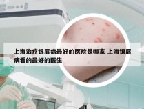 上海治疗银屑病最好的医院是哪家 上海银屑病看的最好的医生