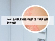 2023治疗银屑病最好的药 治疗银屑病最新特效药