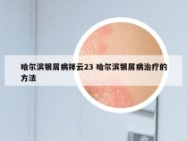 哈尔滨银屑病祥云23 哈尔滨银屑病治疗的方法