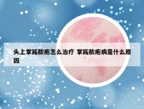 头上掌跖脓疱怎么治疗 掌跖脓疱病是什么原因